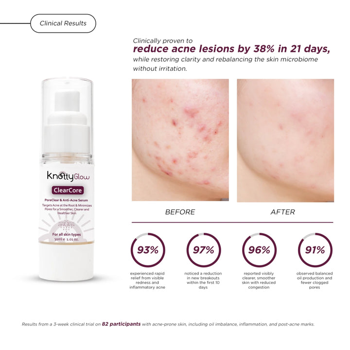 KnottyGlow ClearCore anti-acne serum results to treat breakouts, reduce pimples, and prevent future flare-ups